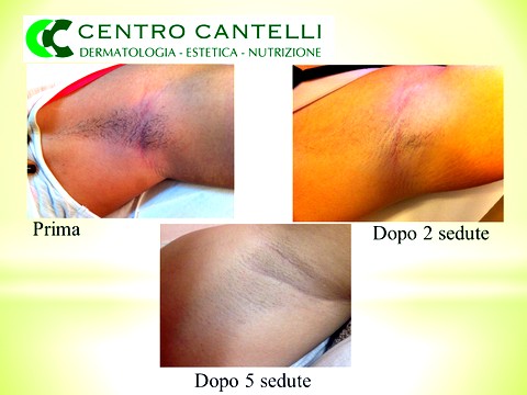 Prima seduta laser diodo medico eseguita ma - Depilazione laser - anturag.info epilazione laser prima seduta