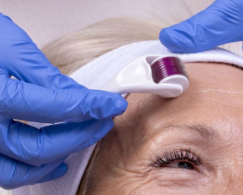 microneedling