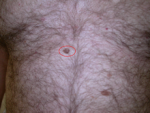 Lesione pigmentata della regione epigastrica