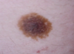 Lesione pigmentata
