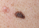 Lesione pigmentata al dorso